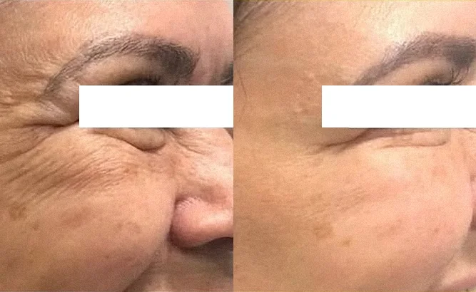 Antes do tratamento da região dos olhos com rugas perioculares mais marcadas